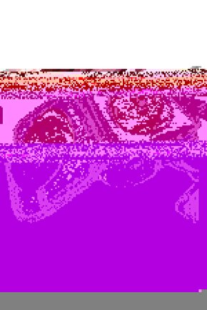 Göğüs Protezi ( Mastektomi Ameliyatı Sonrası )