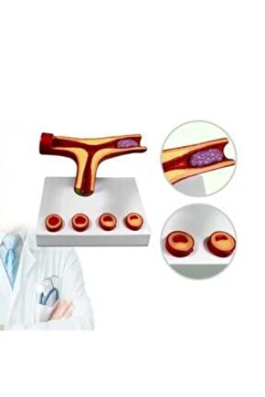 Damar Tıkanıklığı Model46