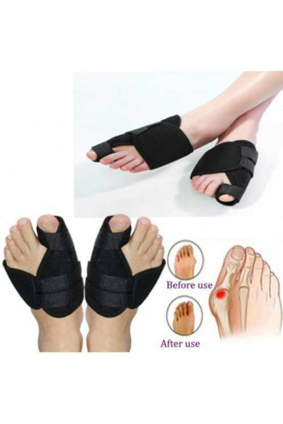 Halluks Valgus Gece Ateli Hallux Valgus Düzeltici Ayak Baş Parmak Kemiği Çıkıntısı